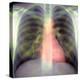 Lungs And Heart, X-ray-Du Cane Medical-Premier Image Canvas