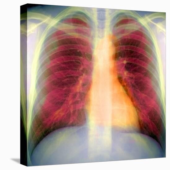 Lungs And Heart, X-ray-Du Cane Medical-Premier Image Canvas