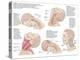 Medical Chart Showing the Range of Injuries to the Human Neck Caused by Whiplash-null-Stretched Canvas