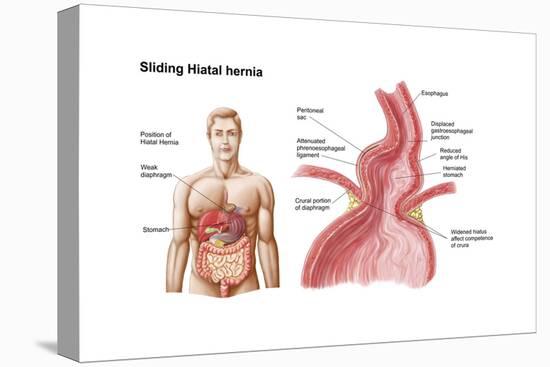 Medical Ilustration of a Hiatal Hernia in the Upper Part of the Stomach into the Thorax-null-Stretched Canvas