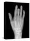 Needle Stuck In Hand, X-ray-Du Cane Medical-Premier Image Canvas
