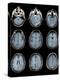 Normal Brain, MRI Scans-ZEPHYR-Premier Image Canvas