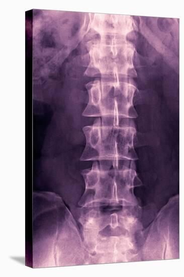 Normal Lumbar Spine, X-ray-Miriam Maslo-Premier Image Canvas