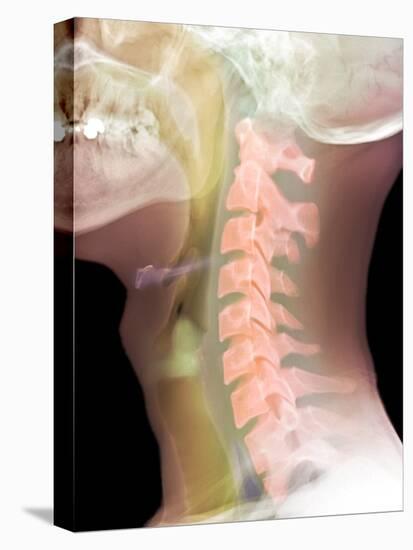 Normal Neck, X-ray-Du Cane Medical-Premier Image Canvas