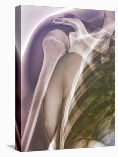 Normal Shoulder, X-ray-ZEPHYR-Premier Image Canvas