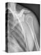 Normal Shoulder, X-ray-ZEPHYR-Premier Image Canvas