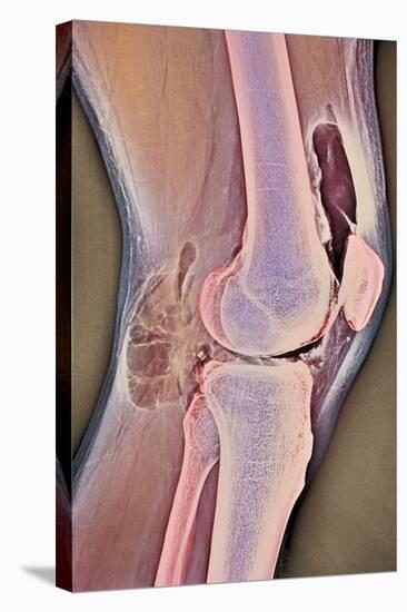 Osteoarthritic Knee X-ray-null-Premier Image Canvas