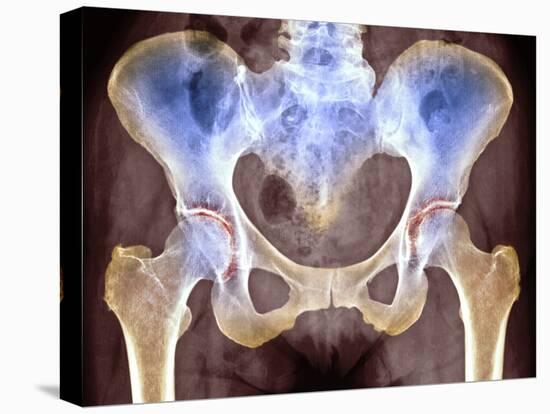 Osteoarthritis of Hip Joints, X-ray-Science Photo Library-Premier Image Canvas