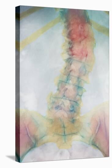 Osteoporosis of Spine, X-ray-Science Photo Library-Premier Image Canvas