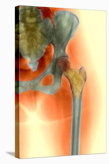 Osteoporosis of the Hip, X-ray-Science Photo Library-Premier Image Canvas