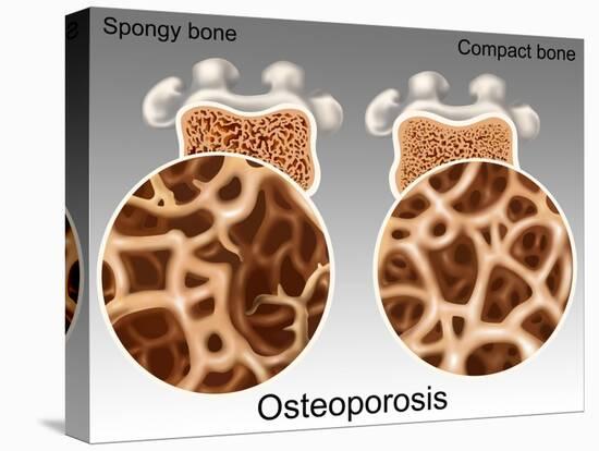 Osteoporotic & Normal Bone-Gwen Shockey-Premier Image Canvas