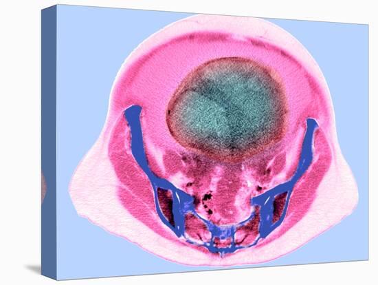Ovarian Cancer, CT Scan-Du Cane Medical-Premier Image Canvas