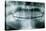 Panoramic Dental X-ray of Impacted Wisdom Teeth-Kaj Svensson-Premier Image Canvas