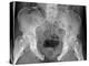 Pelvic Fracture, X-ray-Du Cane Medical-Premier Image Canvas