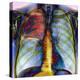 Pneumonia, X-ray-Du Cane Medical-Premier Image Canvas
