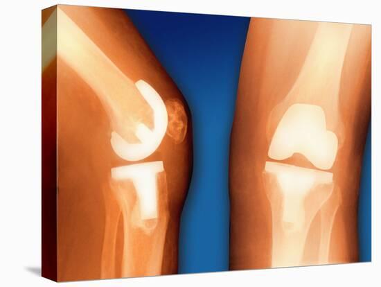 Prosthetic Knee Joint, Coloured X-ray-Miriam Maslo-Premier Image Canvas