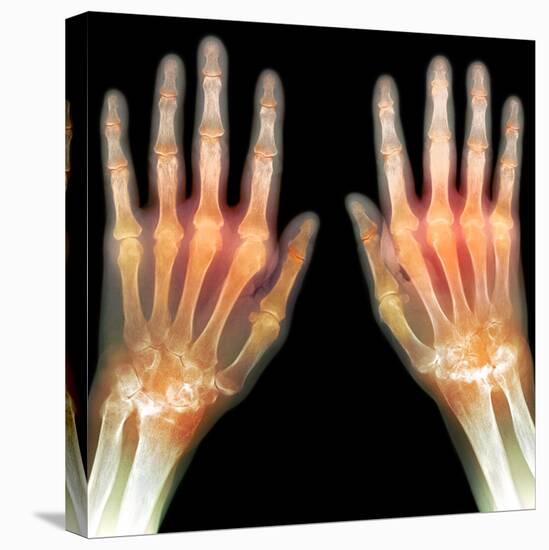 Rheumatoid Arthritis of the Hands, X-ray-Du Cane Medical-Premier Image Canvas