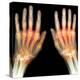 Rheumatoid Arthritis of the Hands, X-ray-Du Cane Medical-Premier Image Canvas