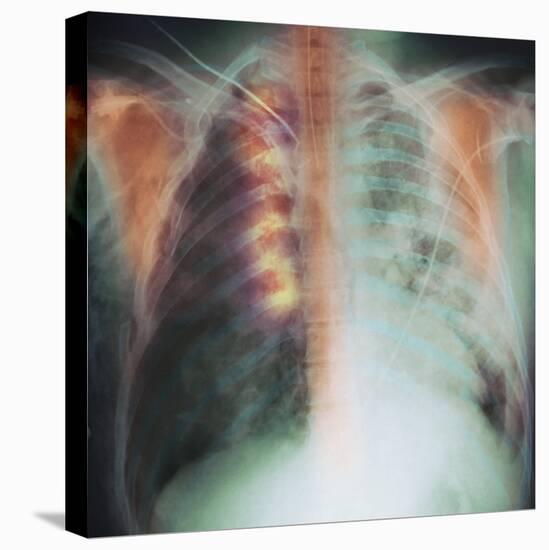Rib Fracture, X-ray-PHT-Premier Image Canvas