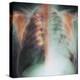 Rib Fracture, X-ray-PHT-Premier Image Canvas