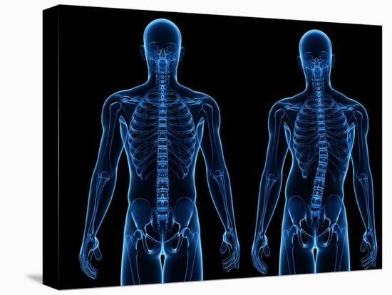 Scoliosis of the Spine, Artwork-SCIEPRO-Premier Image Canvas