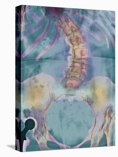 Scoliosis Spine Deformity, X-ray-Science Photo Library-Premier Image Canvas