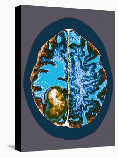 Secondary Brain Cancer, CT Scan-Du Cane Medical-Premier Image Canvas