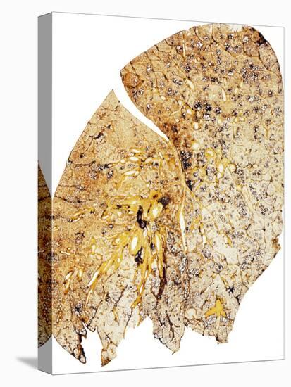 Section of Human Smoker's Lung Showing Tar-James Stevenson-Premier Image Canvas