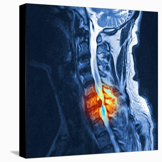 Slipped Disc, MRI Scan-PASIEKA-Premier Image Canvas