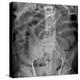 Small Bowel Obstruction, X-ray-Du Cane Medical-Premier Image Canvas