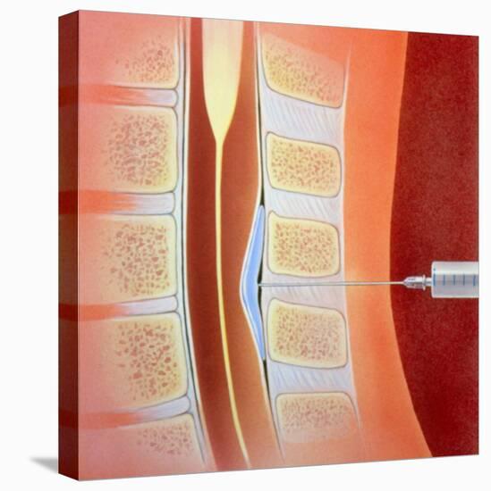 Spinal Epidural Anaesthetic-David Gifford-Premier Image Canvas