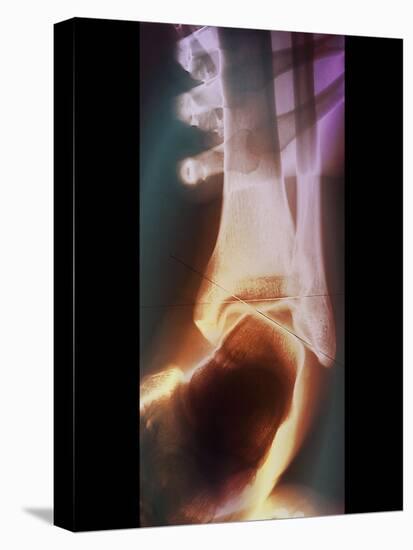 Sprained Ankle, X-ray-ZEPHYR-Premier Image Canvas