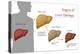 Stages of Liver Damage-Monica Schroeder-Premier Image Canvas