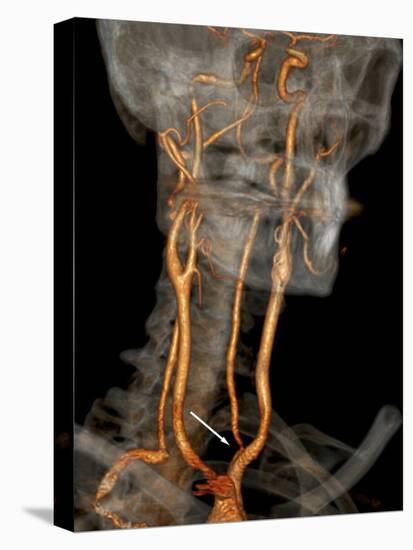 Stenosis of Carotid Artery, CT Scan-ZEPHYR-Premier Image Canvas