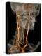 Stenosis of Carotid Artery, CT Scan-ZEPHYR-Premier Image Canvas