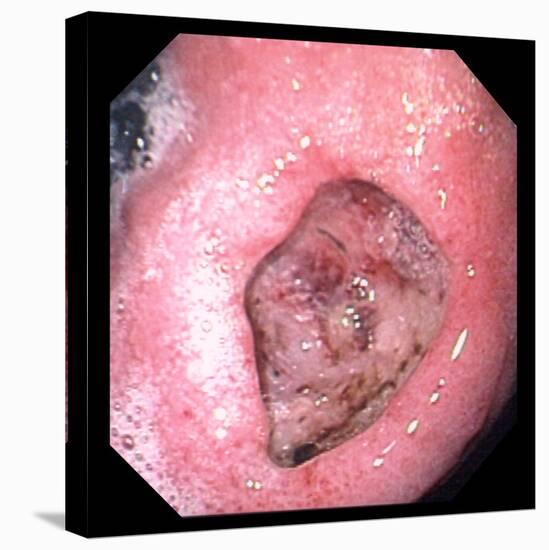 Stomach Ulcer-David Martin-Premier Image Canvas