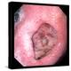 Stomach Ulcer-David Martin-Premier Image Canvas