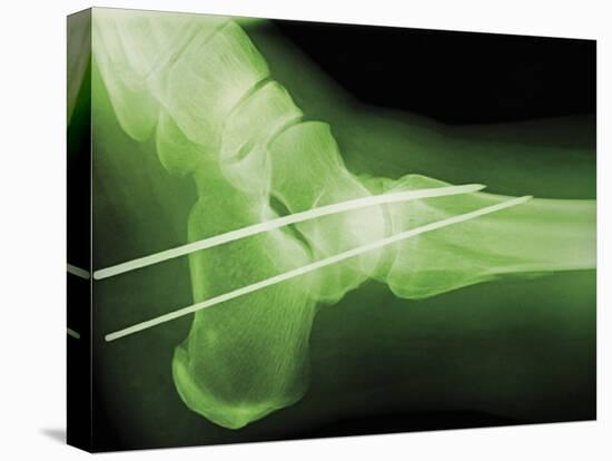 Temporary Ankle Immobilisation, X-ray-Miriam Maslo-Premier Image Canvas