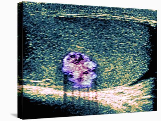 Testicular Cancer, Ultrasound Scan-Du Cane Medical-Premier Image Canvas