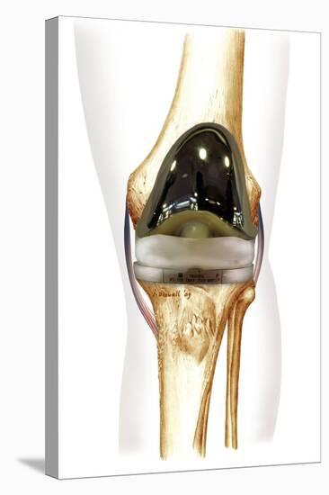 Total Knee Replacement, Artwork-null-Premier Image Canvas