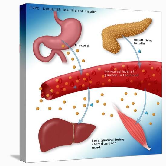 Type I Diabetes-Monica Schroeder-Premier Image Canvas