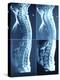 X-Ray Image of Person's Spine on Computer Screen-null-Premier Image Canvas