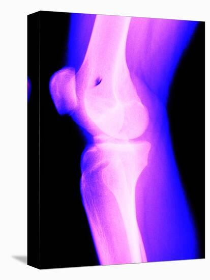 X-Ray of a Knee-null-Premier Image Canvas