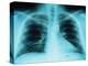 X-Ray of Dark Lungs-Robert Llewellyn-Premier Image Canvas