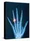 X-ray of hand with diamond ring-Thom Lang-Premier Image Canvas