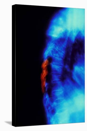 X-ray of Osteoporosis of the Thoracic Spine-Science Photo Library-Premier Image Canvas