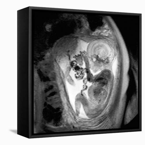 9 Month Foetus, MRI Scan-Du Cane Medical-Framed Premier Image Canvas