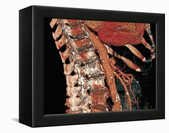 Abdominal Aorta And Spine, 3D CT Scan-Miriam Maslo-Framed Premier Image Canvas