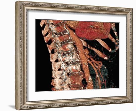 Abdominal Aorta And Spine, 3D CT Scan-Miriam Maslo-Framed Photographic Print