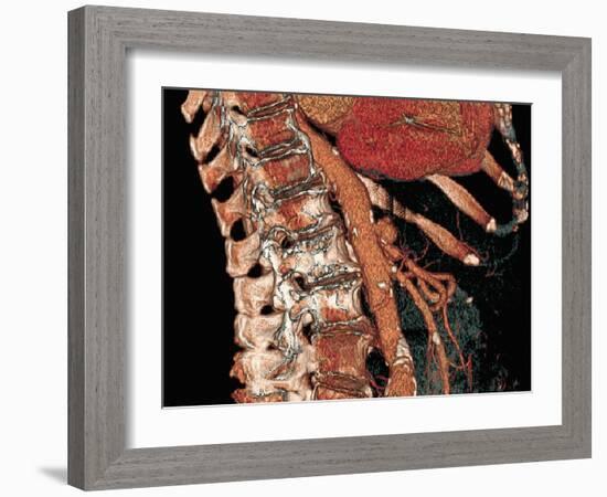 Abdominal Aorta And Spine, 3D CT Scan-Miriam Maslo-Framed Photographic Print